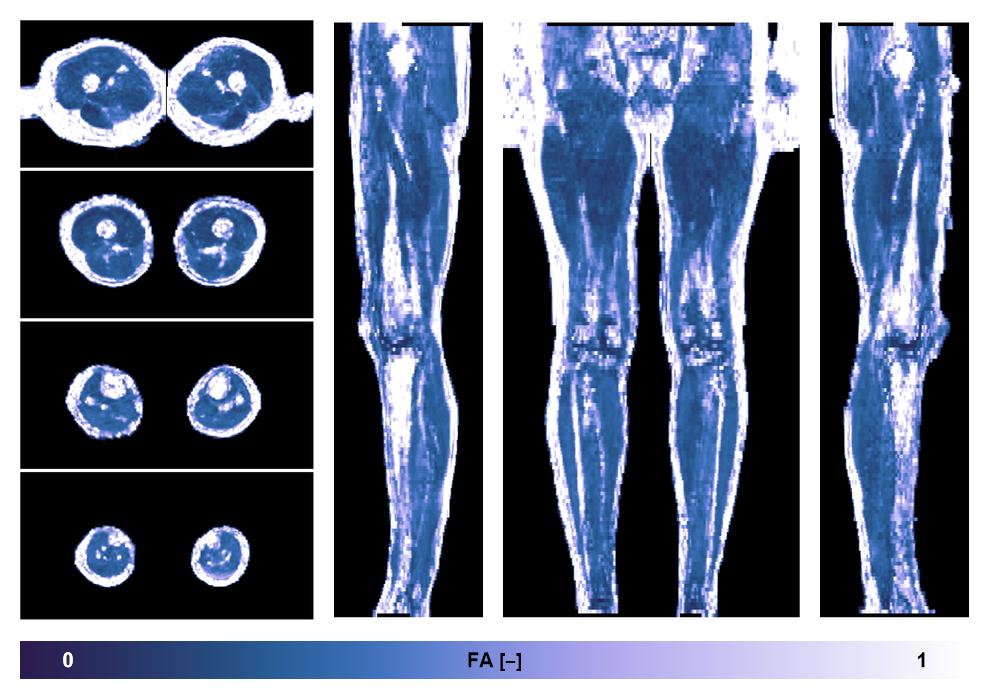 IVIM corrected whole leg muscle fractional anisotropy obtained from diffusion tensor imaging.